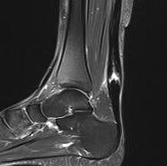 Achilles Tendon Rerupture0001